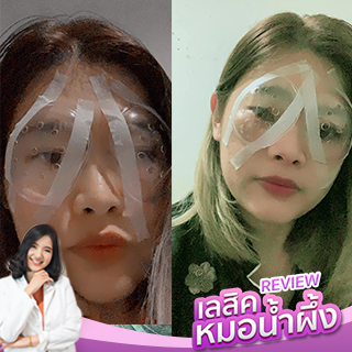 Hx. สายตาสั้นเอียง สั้นน่าจะ250 กว่า เอียง 300 กว่า